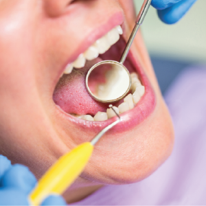 Incrustación dental (en dislicato de litio), tratamientos dentales, clinica dra. tatiana ortiz, cajica