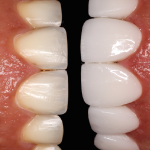 mantenimiento diseño, diseño de sonrisa, sonrisa, sonrisa estetica, tratamiento estetico, tratamientos dentales, col eshtetics, tratamientos dentales