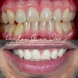 Dr. Carlos Granados, bogotá, tratamientos dentales, odontologia, tratamientos orales, salud oral, dientes, blanqueamientos, valoración dental, servicio de valoracion, col esthetics, carillas, estetica dental, blanqueamiento, rehabilitacion oral, incrustacioones, coronas dentales, limpieza dental