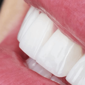 Toxina butolinica, tartamientos faciales, tratamientos dentales, tratamiento bruxismo, medellin, tratamientos esteticos, estetica dental, estetica facial, col esthetics, mantenimiento diseño de sonrisa, diseño de sonrissa, diseño dental, sonrisa perfecta, limpieza dental, profilaxis, skin booster, armonizacion facial, armonizacion orofacial, orofacial, NCTF facial, NCTF, sculptra, sculptra facial, radiesse, acido hialuronico, toxina butolinica, blanqueamiento, odontologia, odontologia estetica, disñeo de sonrisa, cermoreo, resina, diseño de sonrisa en ceromero, diseño de sonrisa en ceramica, diseño de sonrisa resina