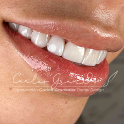 Dr. Carlos Granados, bogotá, tratamientos dentales, odontologia, tratamientos orales, salud oral, dientes, blanqueamientos, valoración dental, servicio de valoracion, col esthetics, carillas, estetica dental, blanqueamiento, rehabilitacion oral, incrustacioones, coronas dentales, diseño de sonrisa