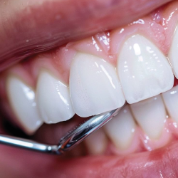 Toxina butolinica, bruxismo, tartamientos faciales, tratamientos dentales, tratamiento bruxismo, medellin, tratamientos esteticos, estetica dental, estetica facial, col esthetics, mantenimiento diseño de sonrisa, diseño de sonrissa, diseño dental, sonrisa perfecta, limpieza dental, profilaxis