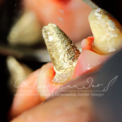 Dr. Carlos Granados, bogotá, tratamientos dentales, odontologia, tratamientos orales, salud oral, dientes, blanqueamientos, valoración dental, servicio de valoracion, col esthetics, carillas, estetica dental, blanqueamiento, rehabilitacion oral, incrustacioones, coronas dentales